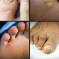 Expert Insights: Understanding and Treating Common Foot Disorders