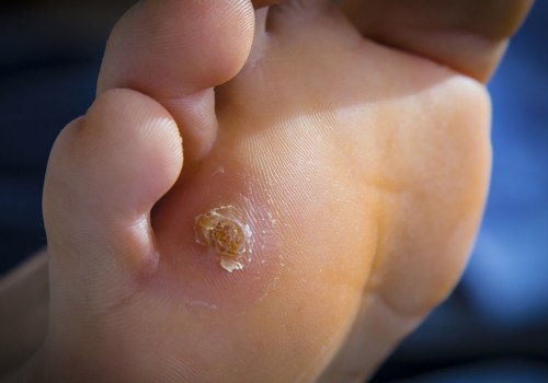 Expert Insights: The Impact of Foot Diseases on Your Health