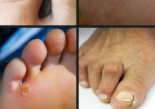 Expert Insights: The Top 10 Foot Disorders and How to Treat Them