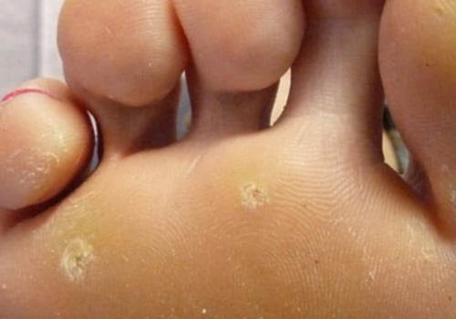 Expert Insights: The Most Common Foot Problems and How to Treat Them